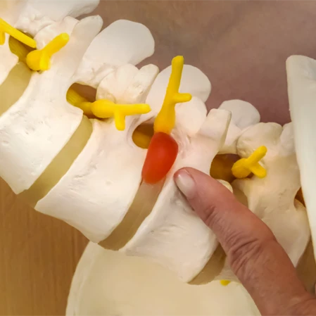 Chiropractic Ventura CA Herniated Disc